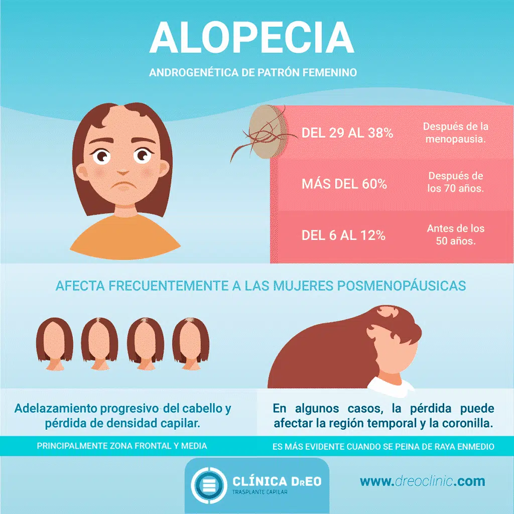 alopecia androgenetica patron femenino