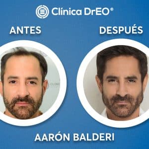 Mejores Clínicas de Injerto de Cabello en México