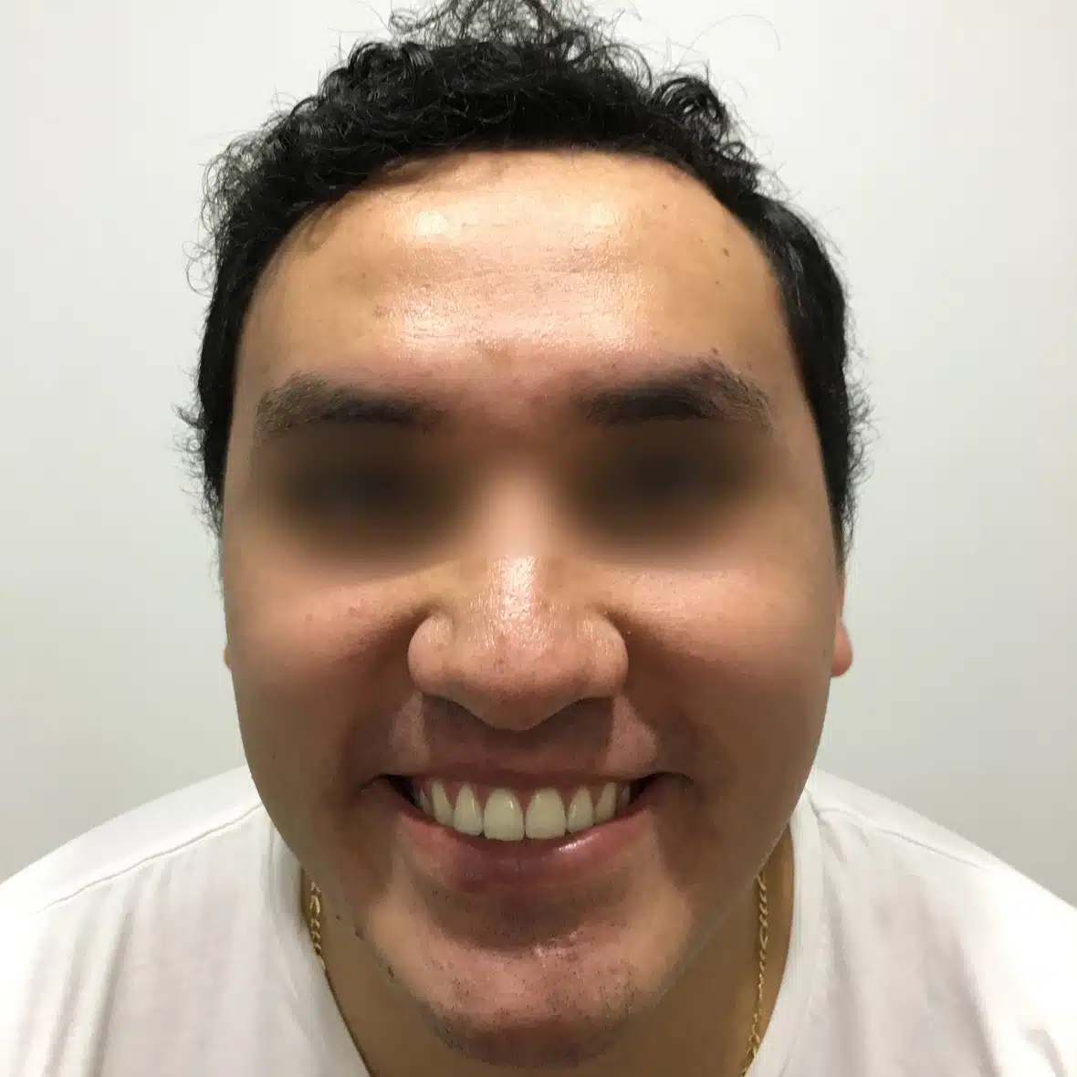 Injerto de Barba y Bigote 18 1 1