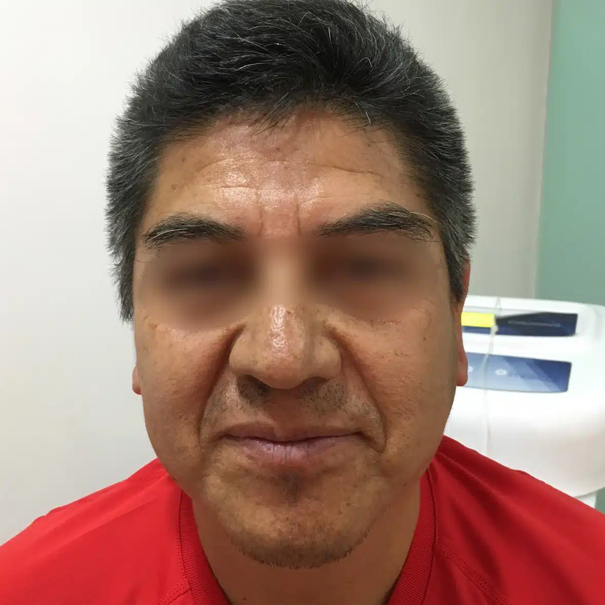 Injerto de Barba y Bigote 22 3 1