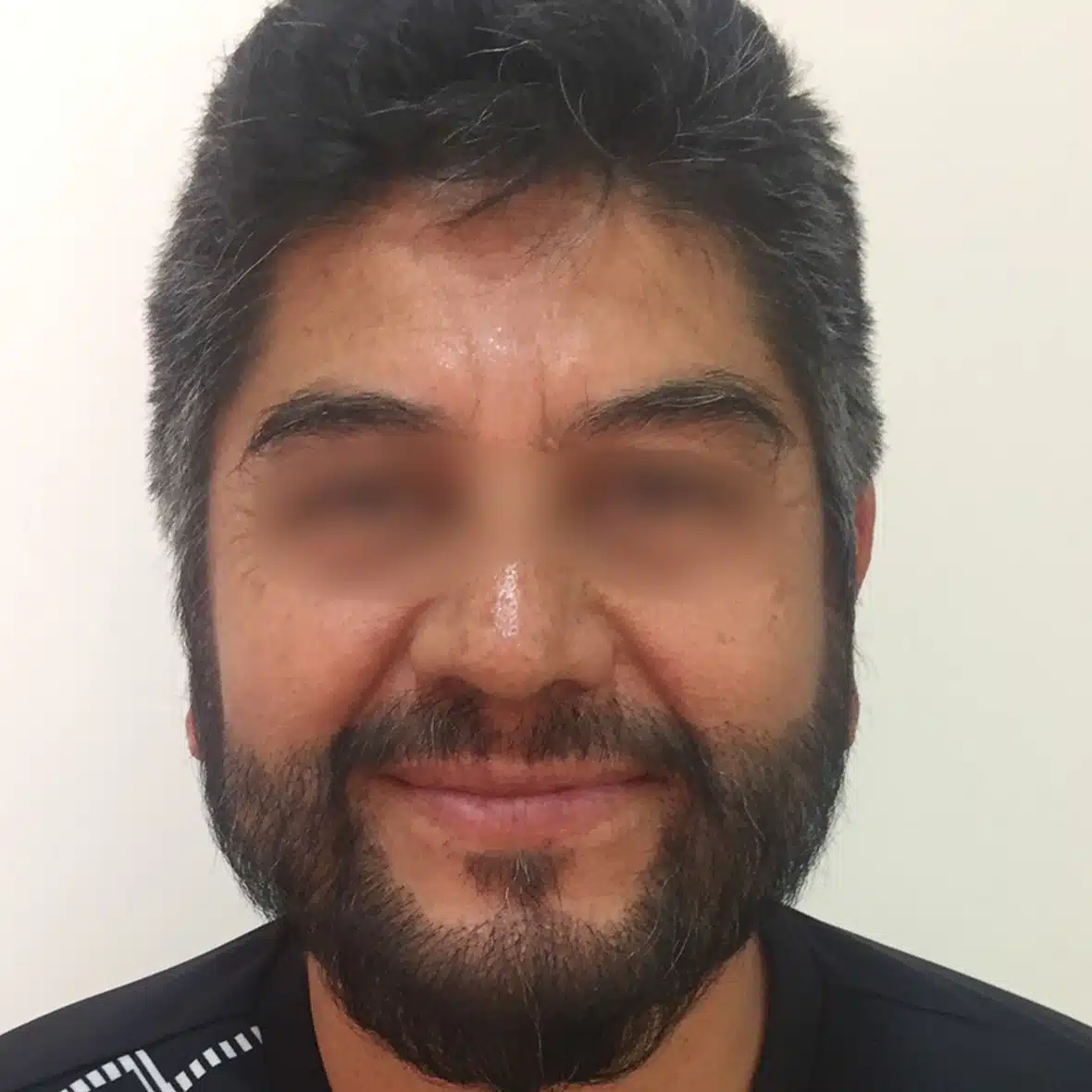 Injerto de Barba y Bigote 23 4 1