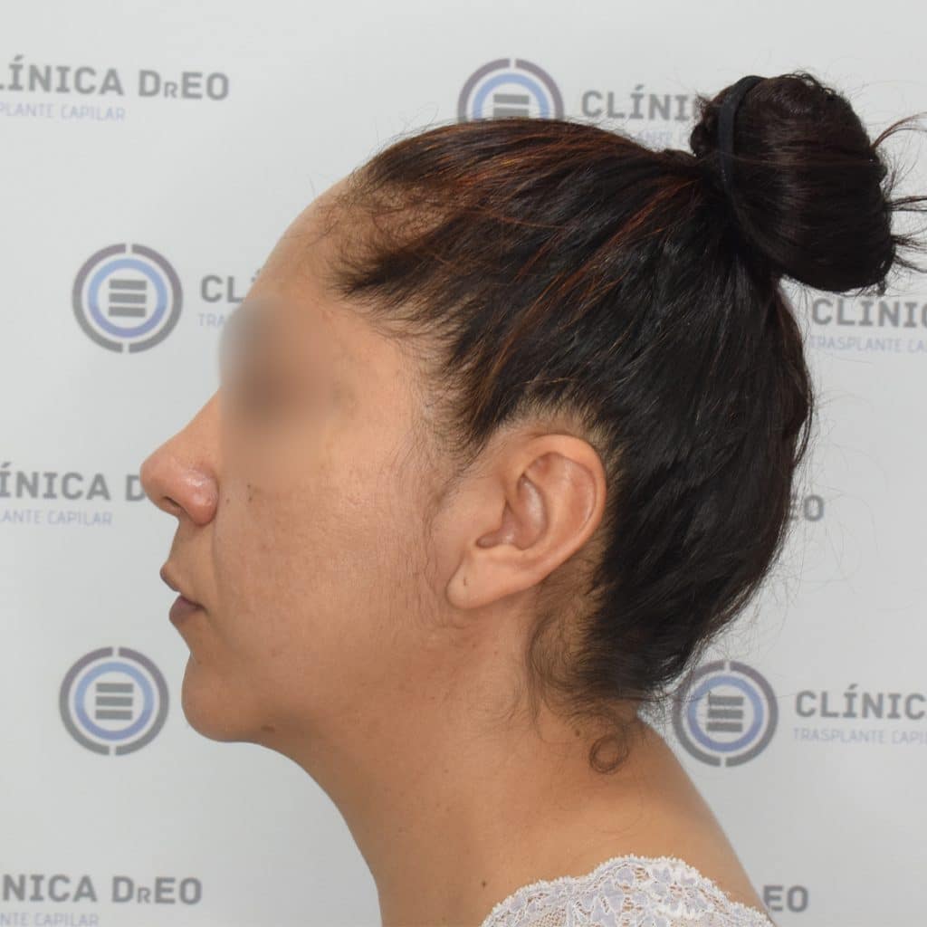 Alopecia femenina e injerto capilar