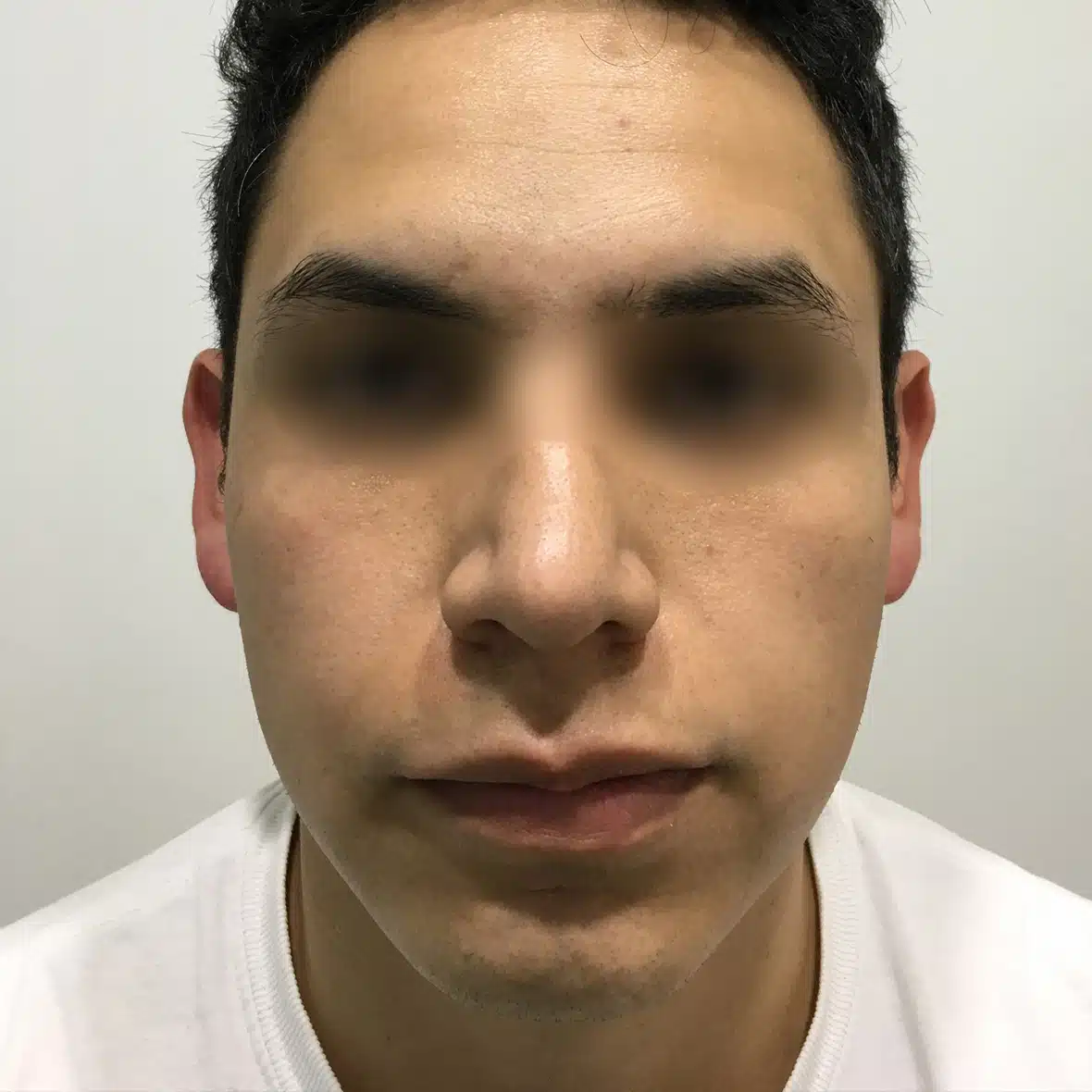 Injerto de Barba y Bigote 20 5 1