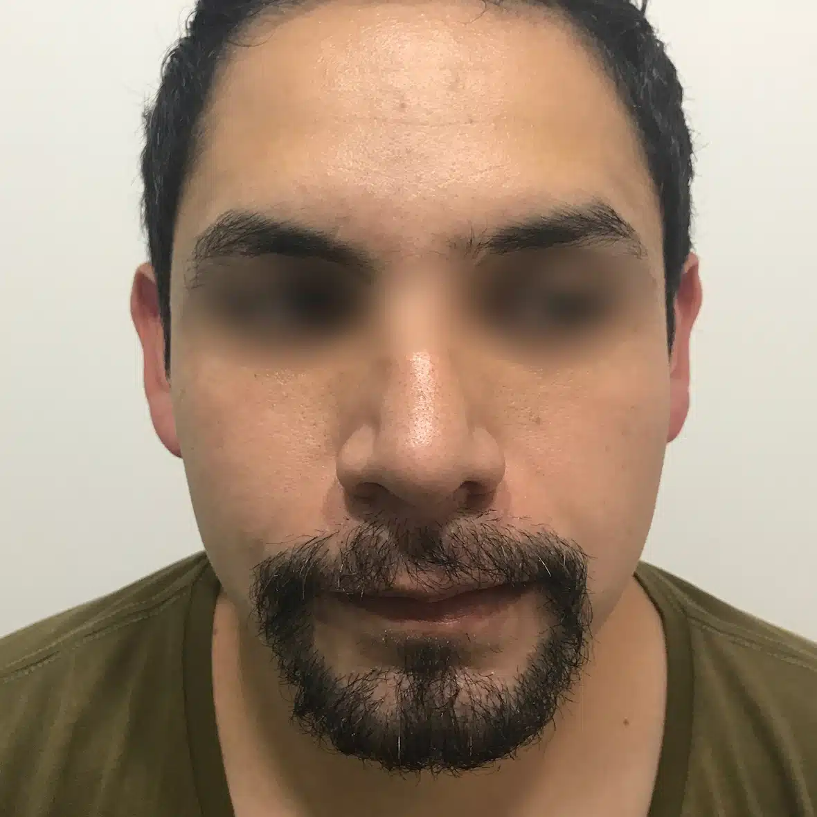 Injerto de Barba y Bigote 21 6 1