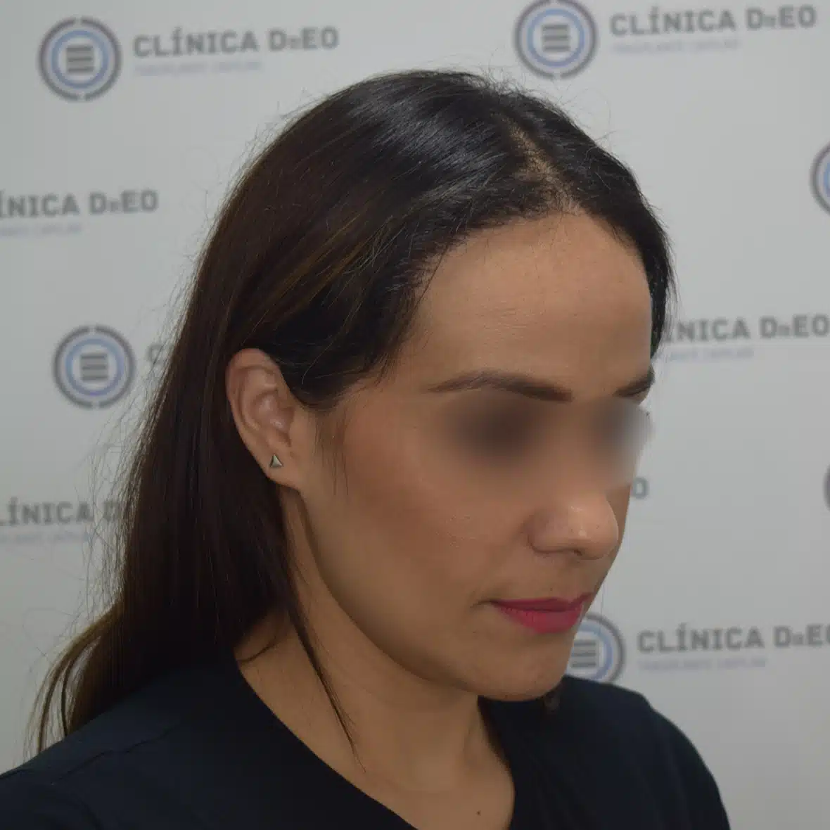 Trasplante de Cabello en Mujeres 3 6