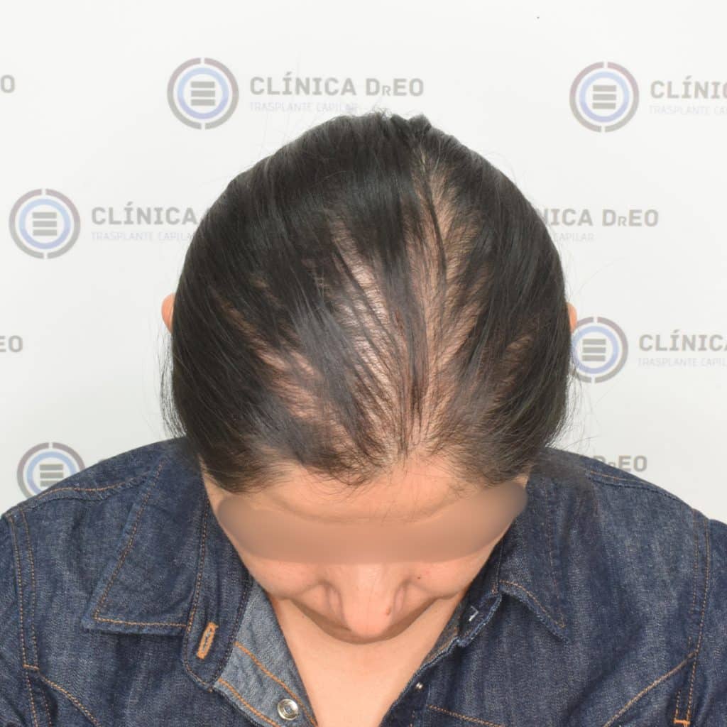 Evaluación de pérdida de cabello en mujeres