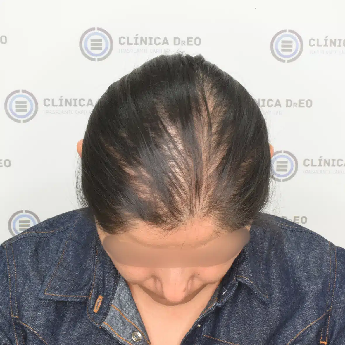 Trasplante de Cabello en Mujeres 4 7