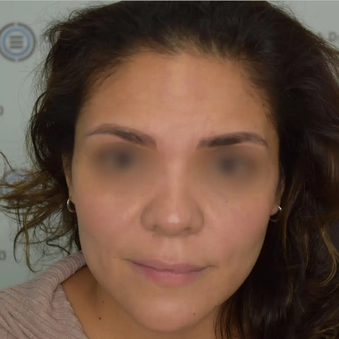 Injerto de Ceja y Pestaña 20 8 1