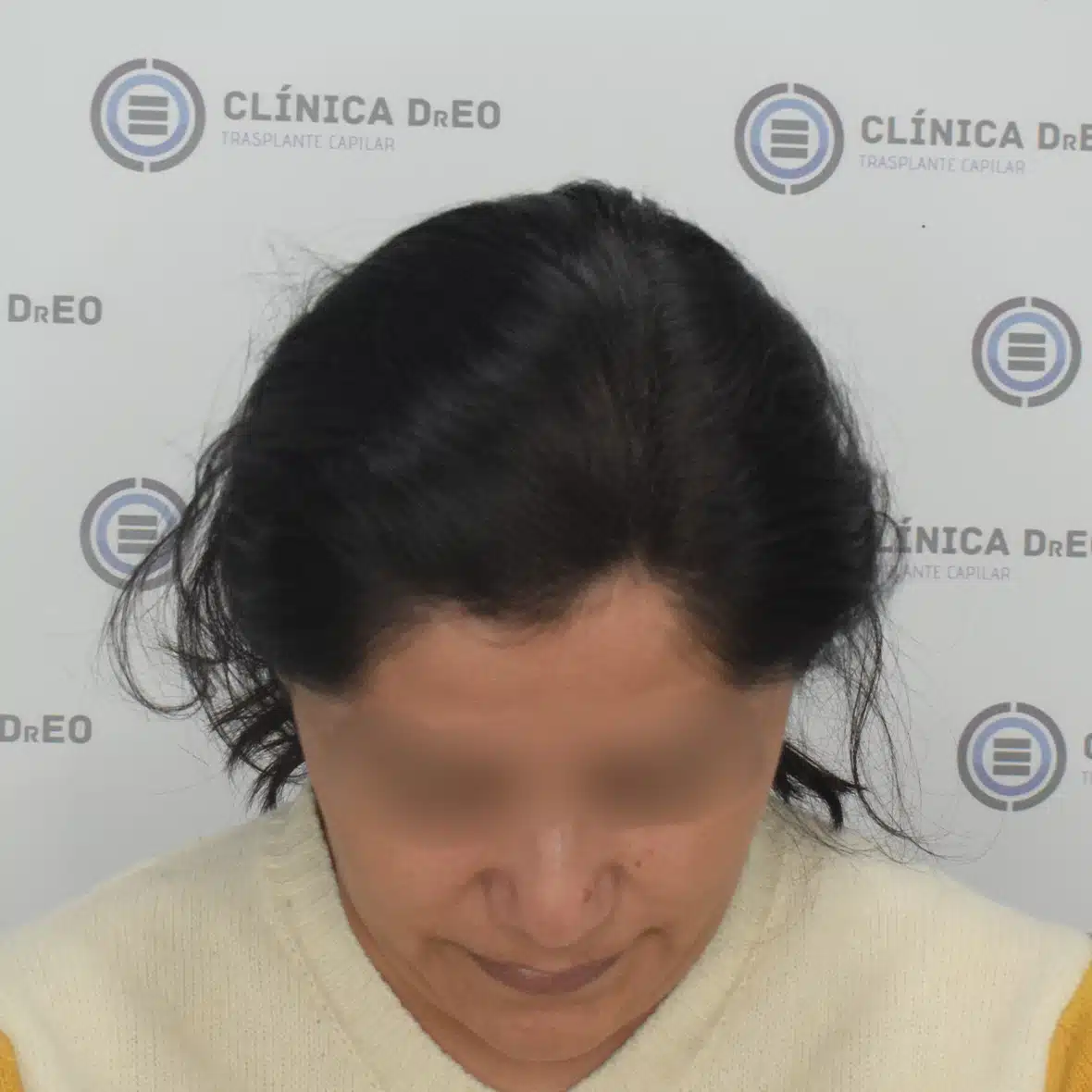 Trasplante de Cabello en Mujeres 5 8