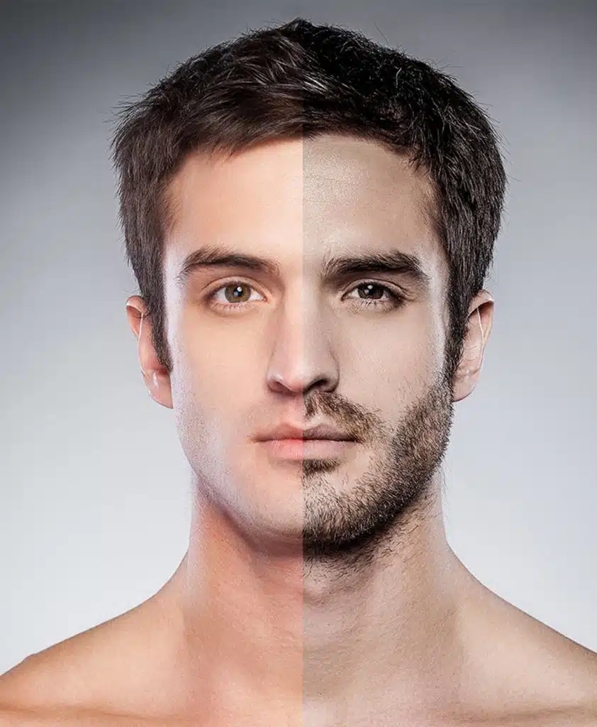 Injerto de Barba y Bigote 17 open service 2