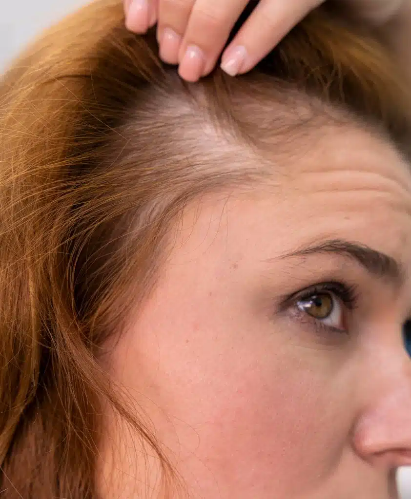Trasplante de Cabello en Mujeres 1 Injerto de cabello en mujeres