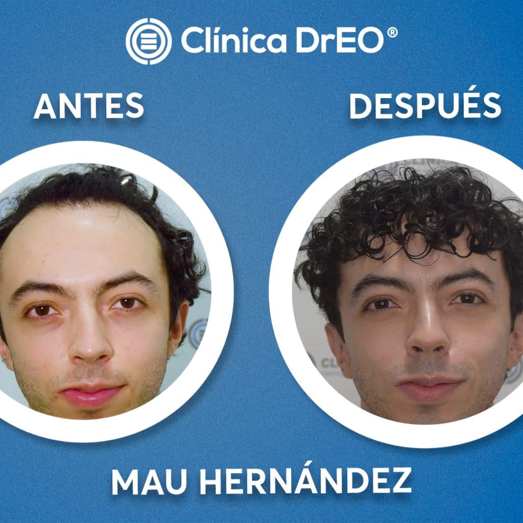 Cuanto cuesta un implante de cabello