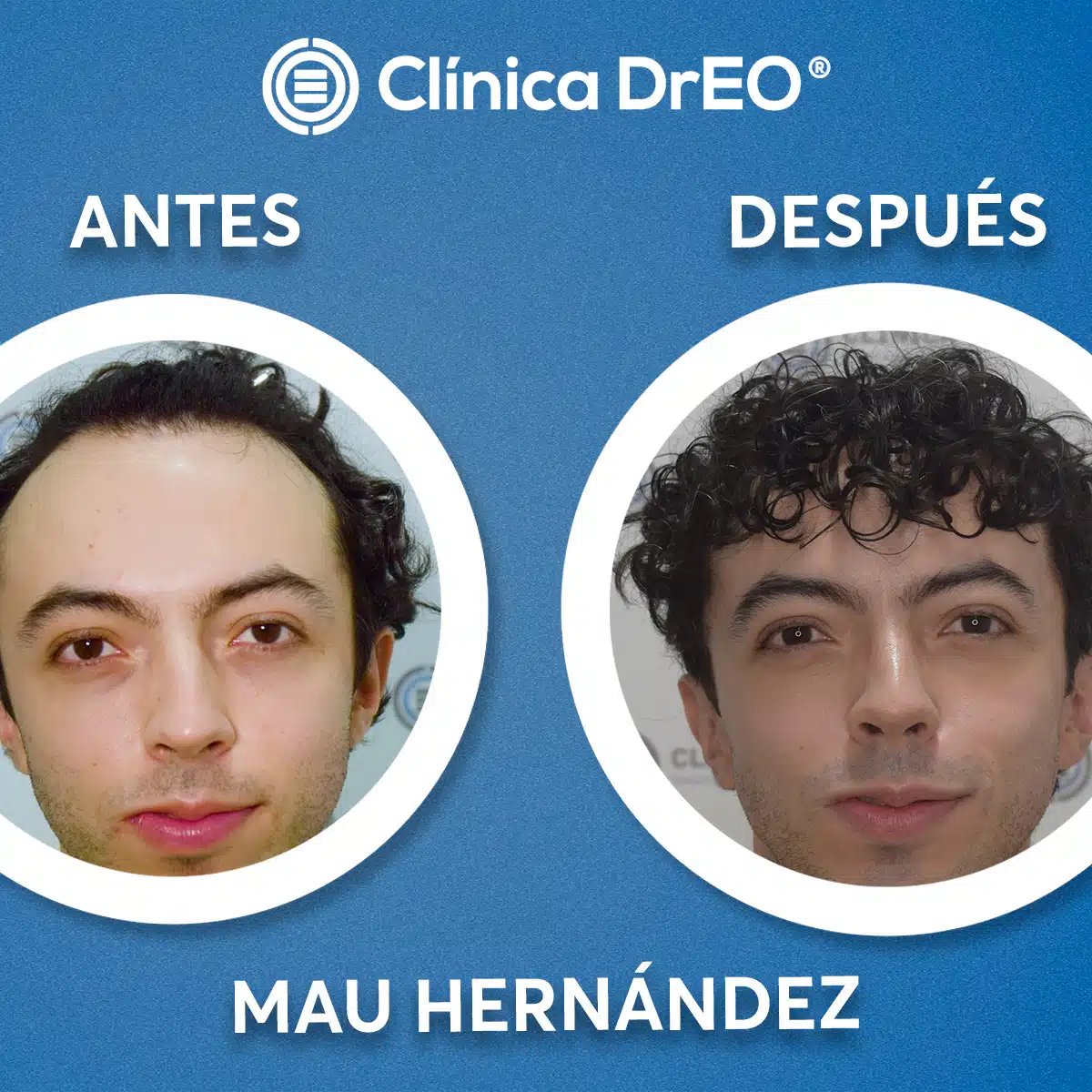 Dr. Martín Torrejón 2 Cuanto cuesta un implante de cabello