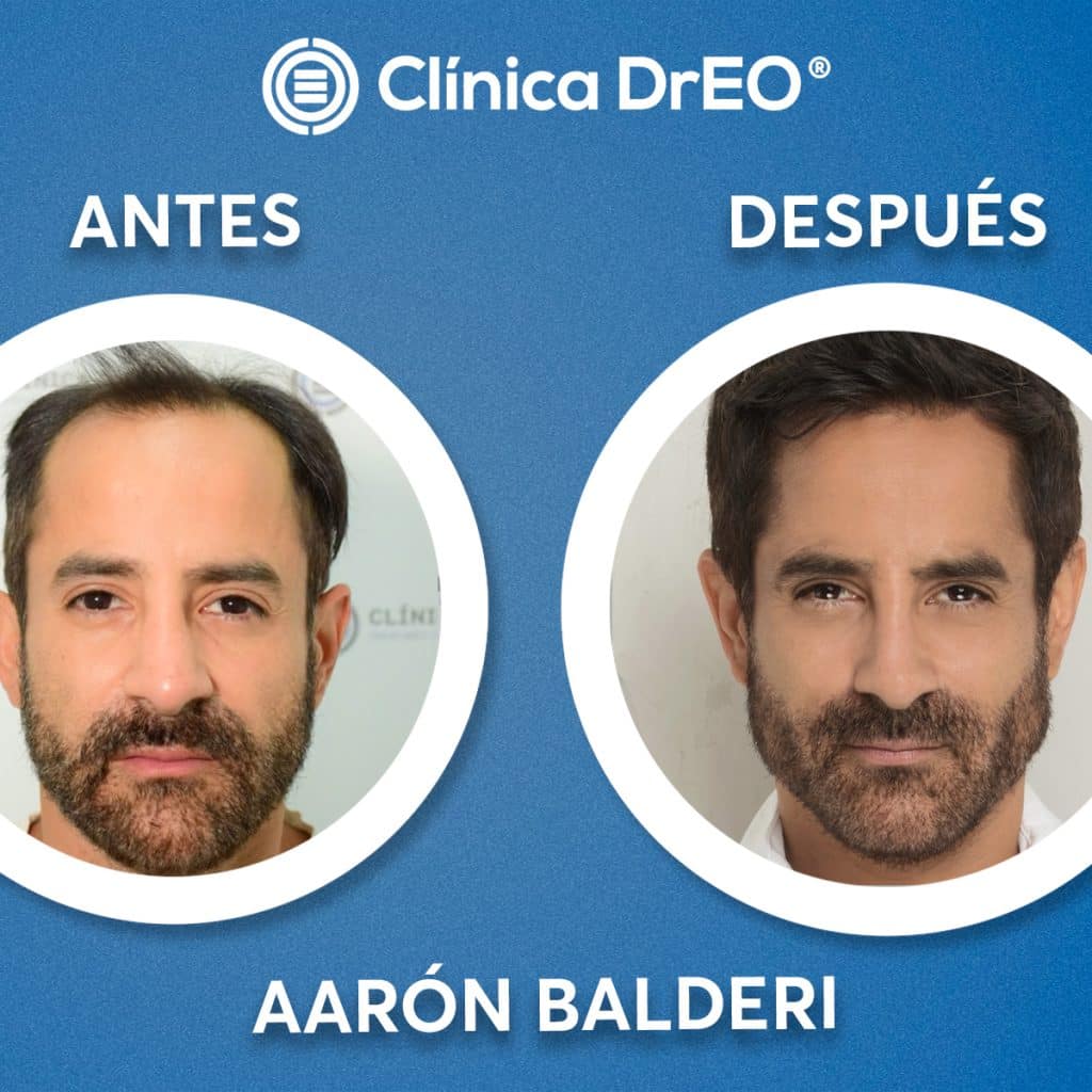 Cuánto cuesta un trasplante de pelo en México