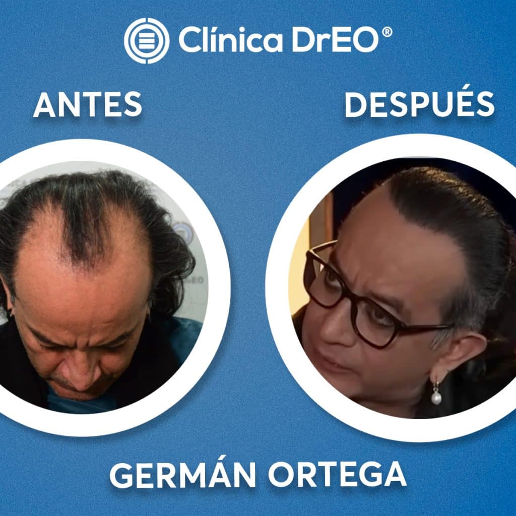 ¿Cuánto Cuesta un Injerto de Cabello en México? Sorpréndete 4 Injerto Capilar Precio