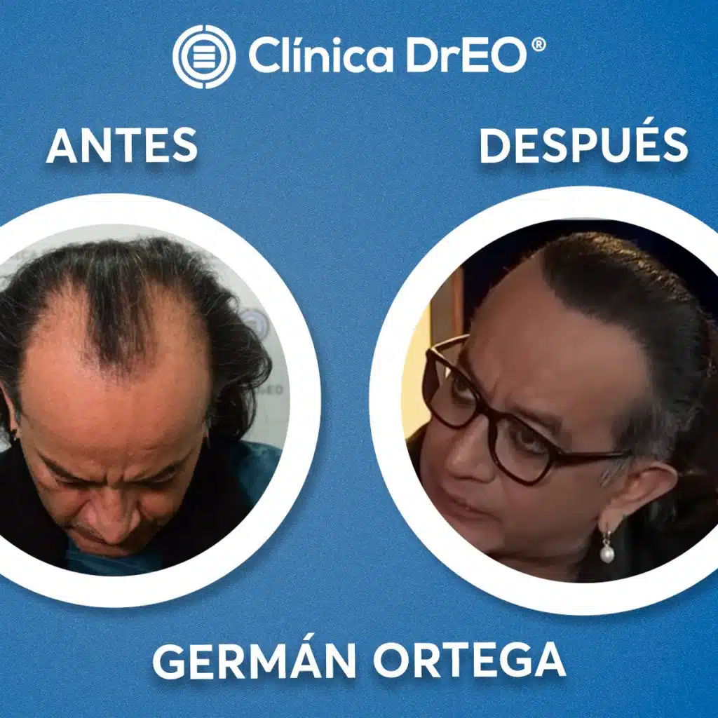 🚨¿Cuánto Cuesta un Injerto de Cabello en México? Desde 20,000 pesos 😲 4 Injerto Capilar Precio