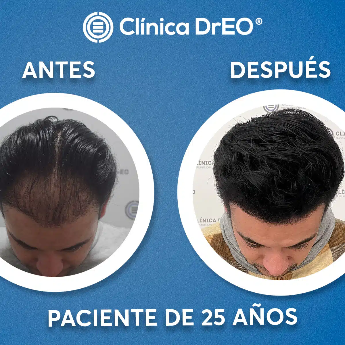 Dr. Martín Torrejón 3 Injerto de cabello costo