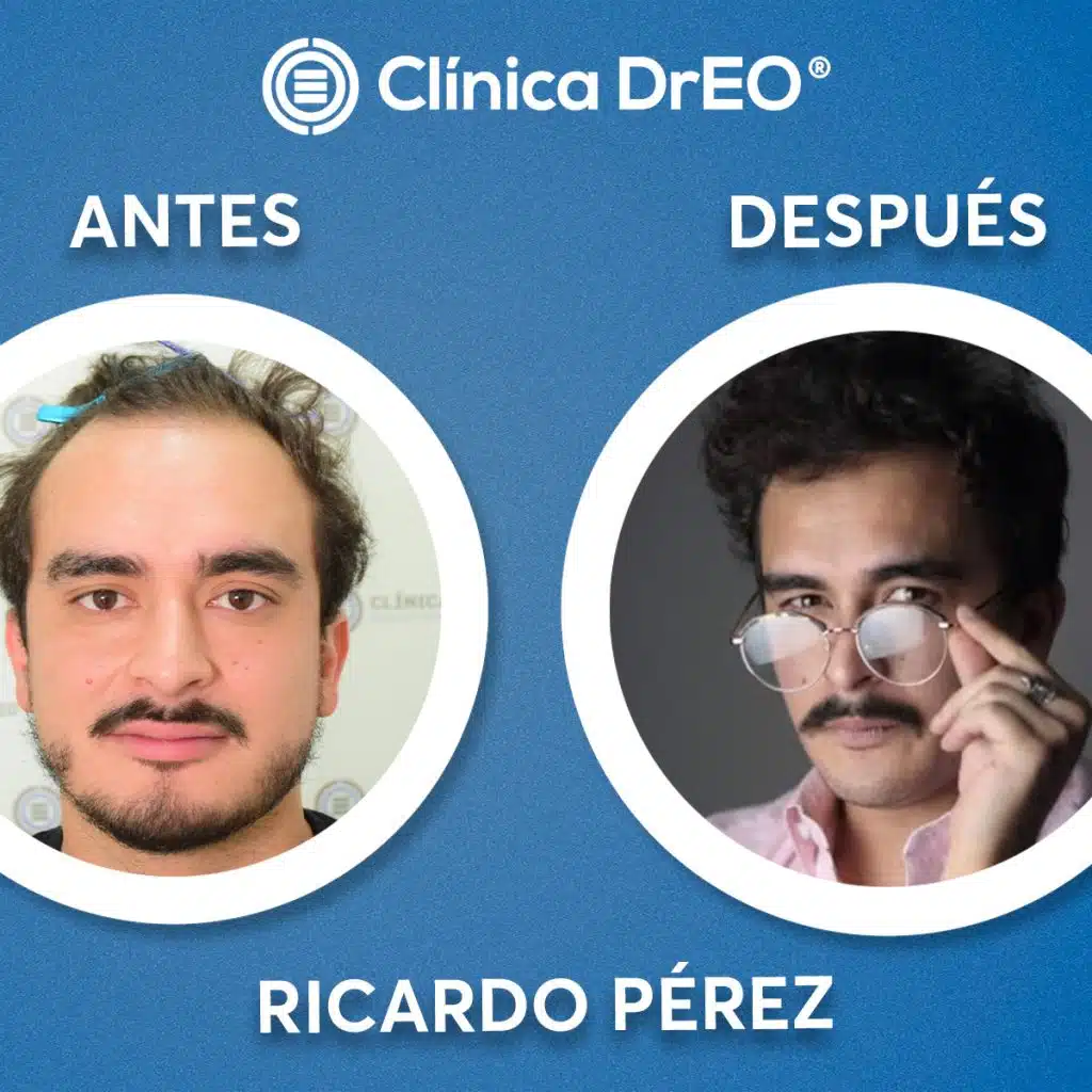 🚨¿Cuánto Cuesta un Injerto de Cabello en México? Desde 20,000 pesos 😲 5 Injerto de cabello precio