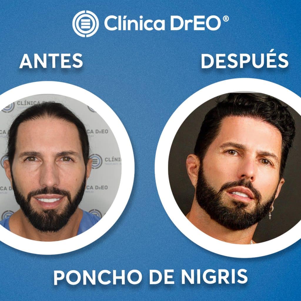 ¿Cuánto Cuesta un Injerto de Cabello en México? Sorpréndete 1 Cuánto cuesta un injerto de cabello en México