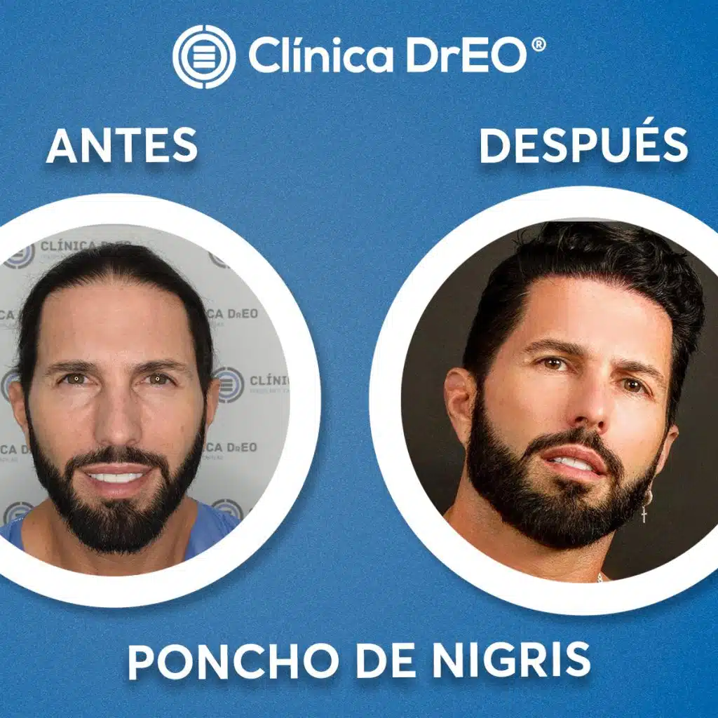 🚨¿Cuánto Cuesta un Injerto de Cabello en México? Desde 20,000 pesos 😲 1 Cuánto cuesta un injerto de cabello en México