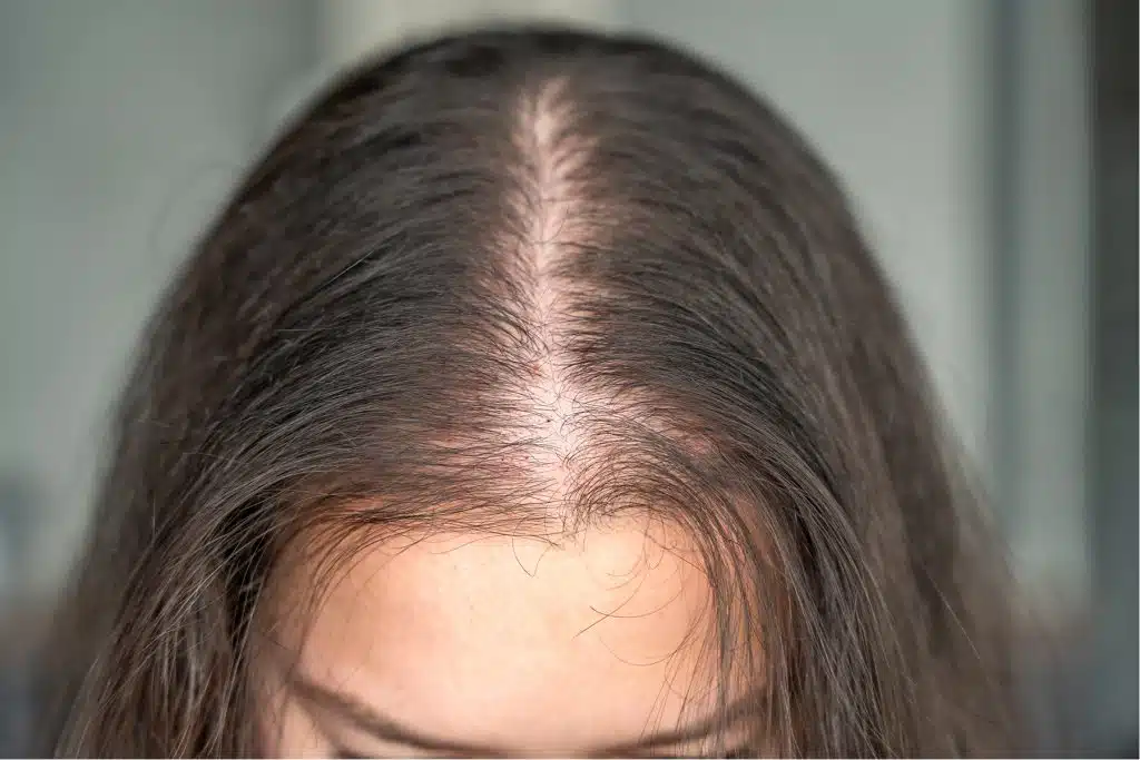 7 enfermedades que causan la caída del cabello en mujeres y cómo tratarlas 1 Mujer con adelgazamiento progresivo del cabello en la línea central, signo común de alopecia androgenética femenina