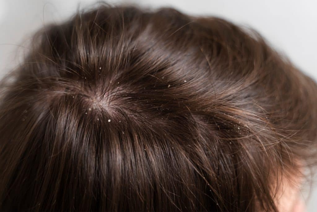 Psoriasis en la cabeza: 5 causas, síntomas y tratamientos efectivos 5 Convivir con la psoriasis en la cabeza un proceso posible