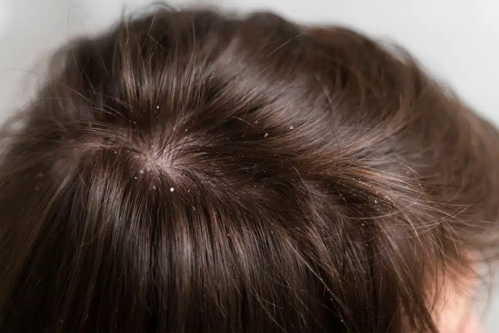 Psoriasis en la cabeza: 5 causas, síntomas y tratamientos efectivos 5 Convivir con la psoriasis en la cabeza un proceso posible