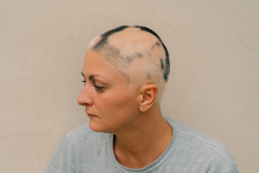 7 enfermedades que causan la caída del cabello en mujeres y cómo tratarlas 2 Mujer con pérdida avanzada de cabello asociada a una condición médica que afecta el cuero cabelludo