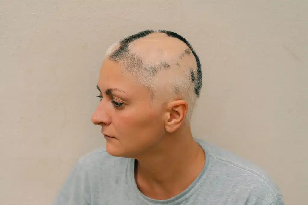 7 enfermedades que causan la caída del cabello en mujeres y cómo tratarlas 2 Mujer con pérdida avanzada de cabello asociada a una condición médica que afecta el cuero cabelludo