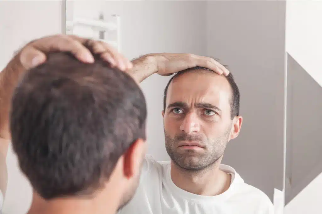 Alopecia por estrés: lo que dice la ciencia y 5 soluciones existen 5 La caida de cabello por estres se detiene sola