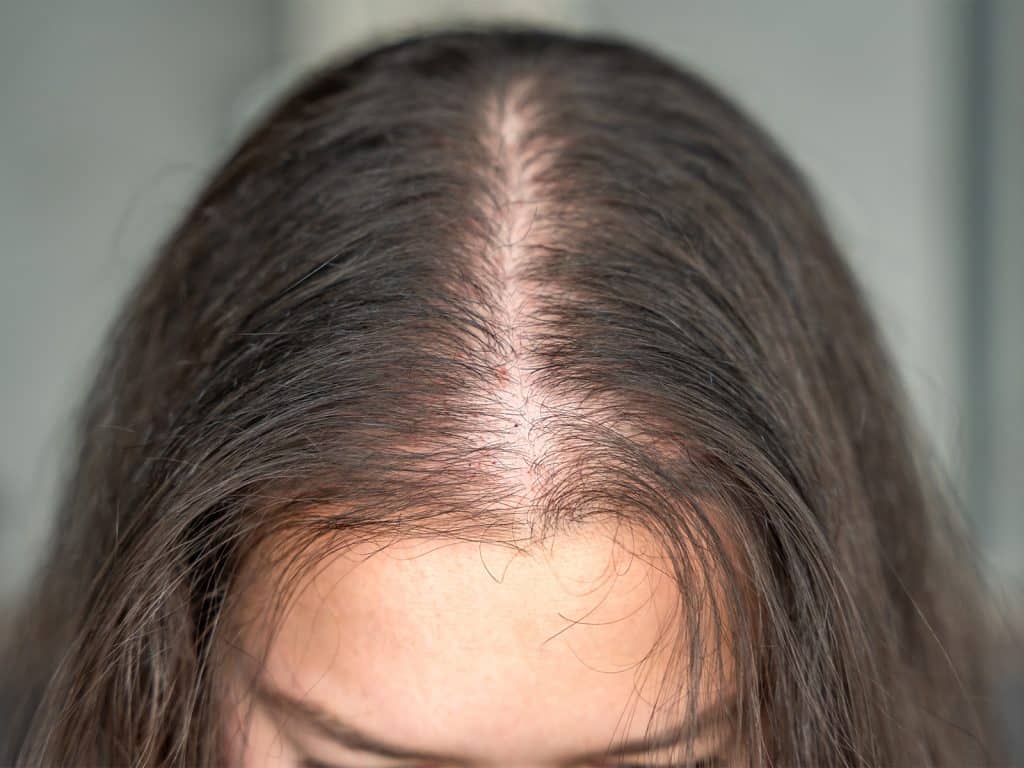 Alopecia en mujeres: 4 tipos y cómo identificarla a tiempo 1 Que es la alopecia en mujeres