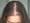 Que es la alopecia en mujeres