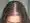 Que es la alopecia en mujeres