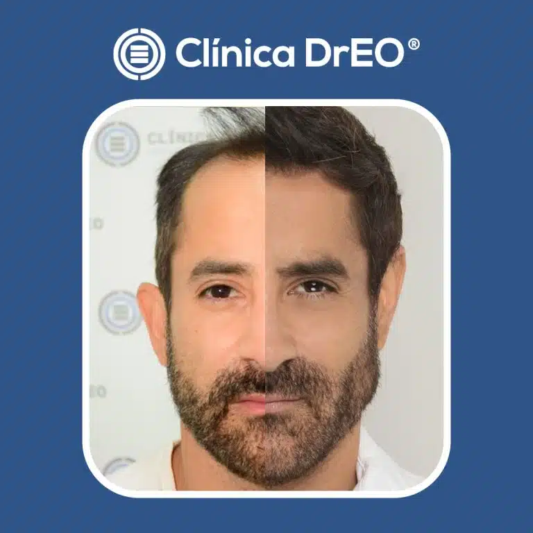 Injerto Capilar