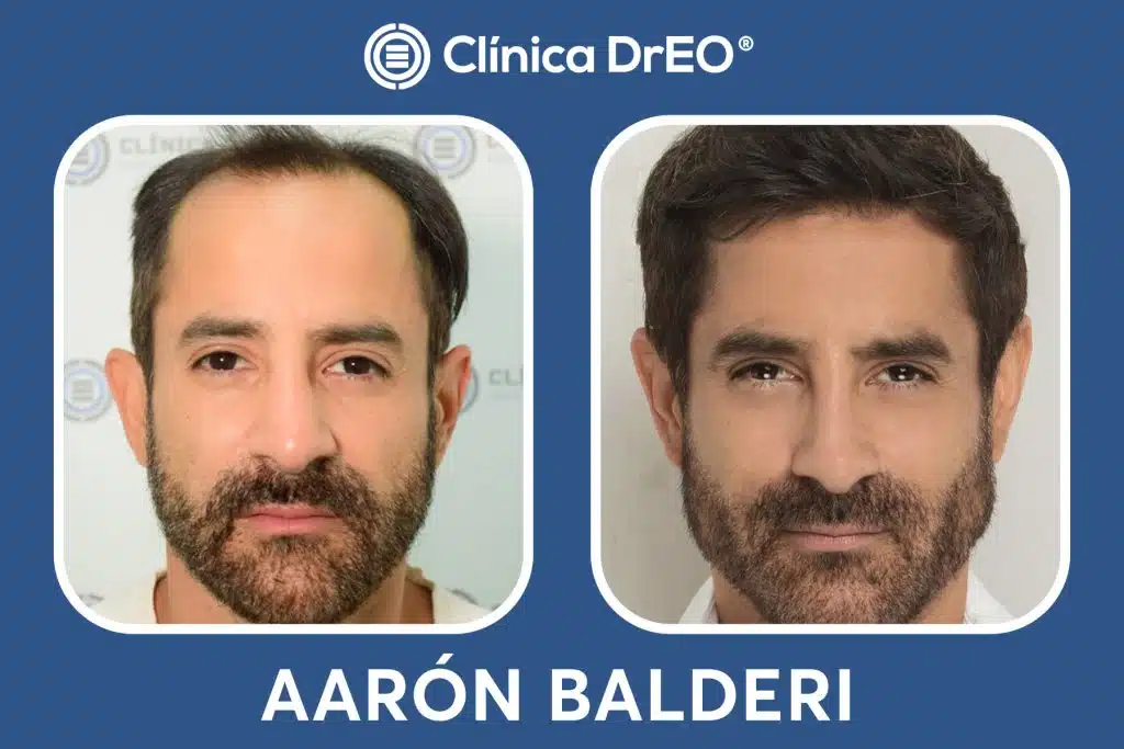 Resultados Injerto Capilar Aaron Balderi