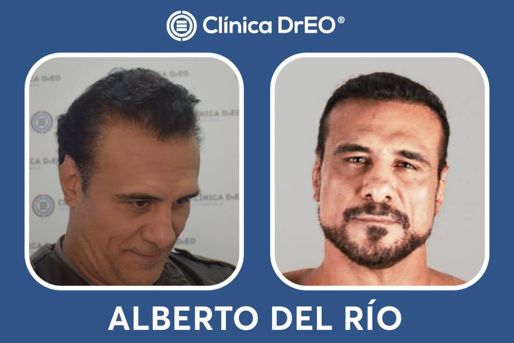 Injerto Capilar: Resultados Antes y Después Reales 7 Resultados Injerto Capilar Alberto del Rio