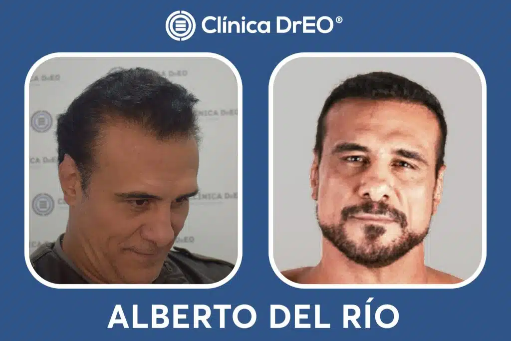 Resultados Injerto Capilar Alberto del Rio