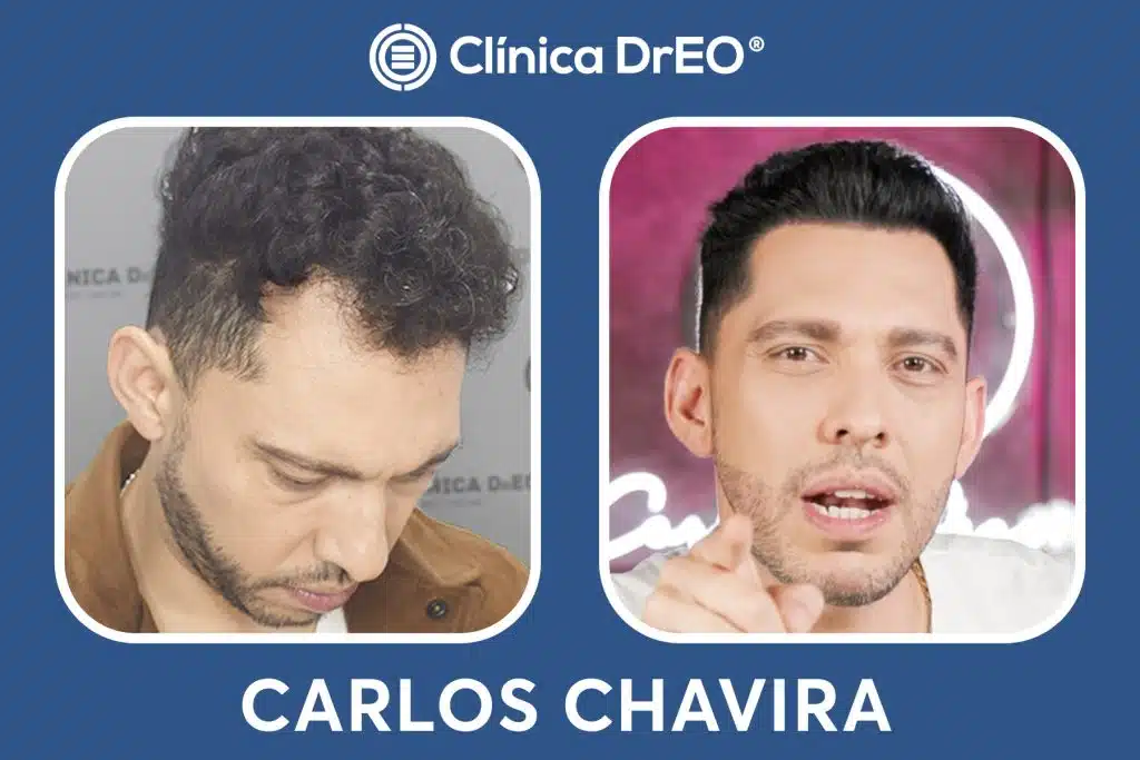Resultados Injerto Capilar Carlos Chavira