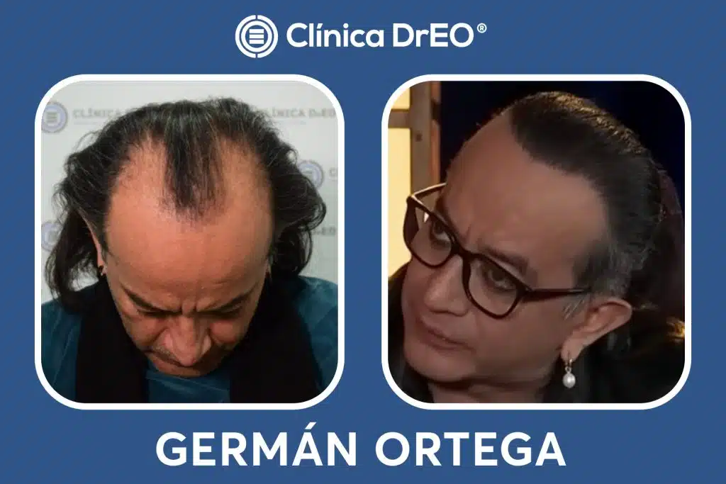 Resultados Injerto Capilar German Ortega