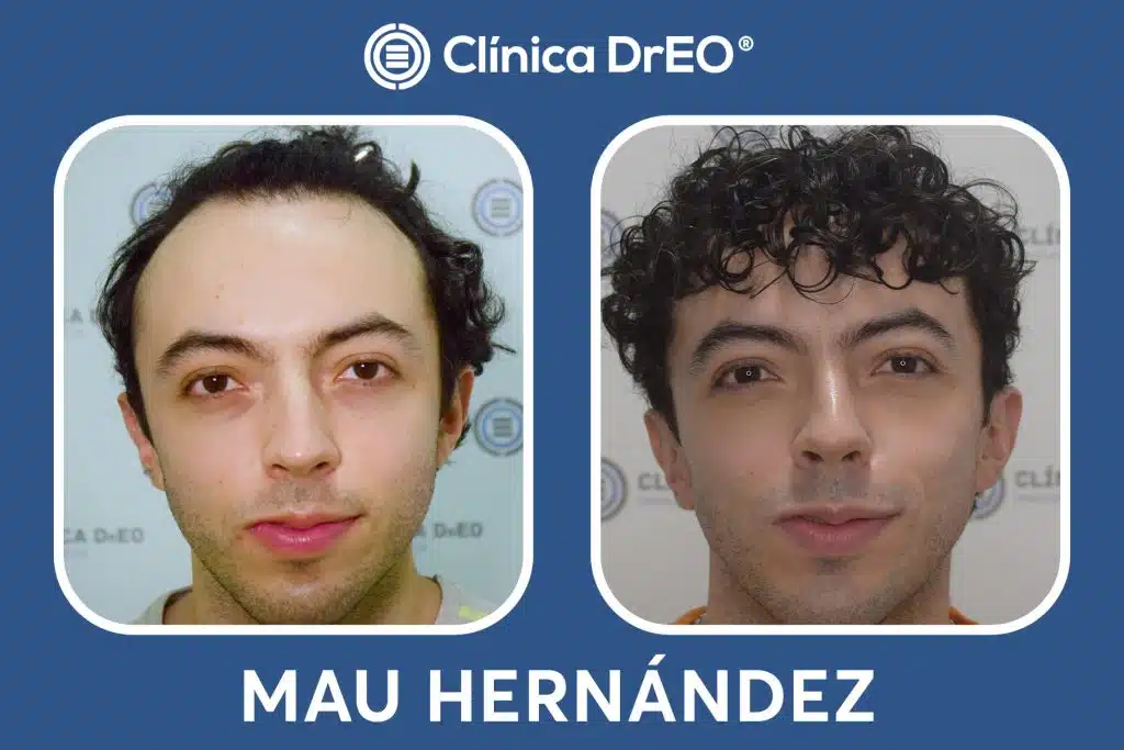 Resultados Injerto Capilar Mau Hernandez