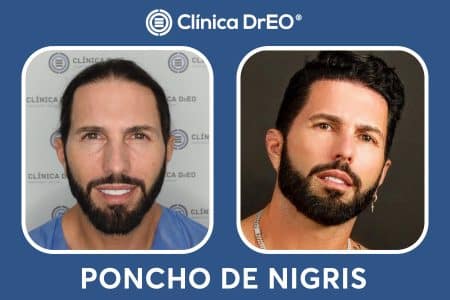 poncho denigris despues de su injerto capilar