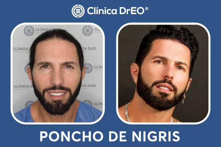 poncho denigris despues de su injerto capilar