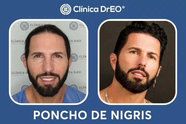 poncho denigris despues de su injerto capilar
