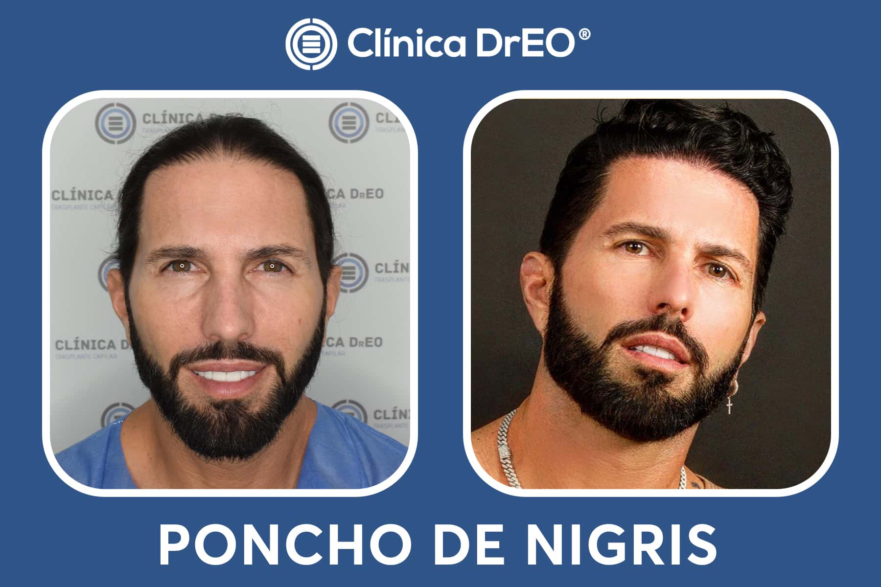 poncho denigris despues de su injerto capilar