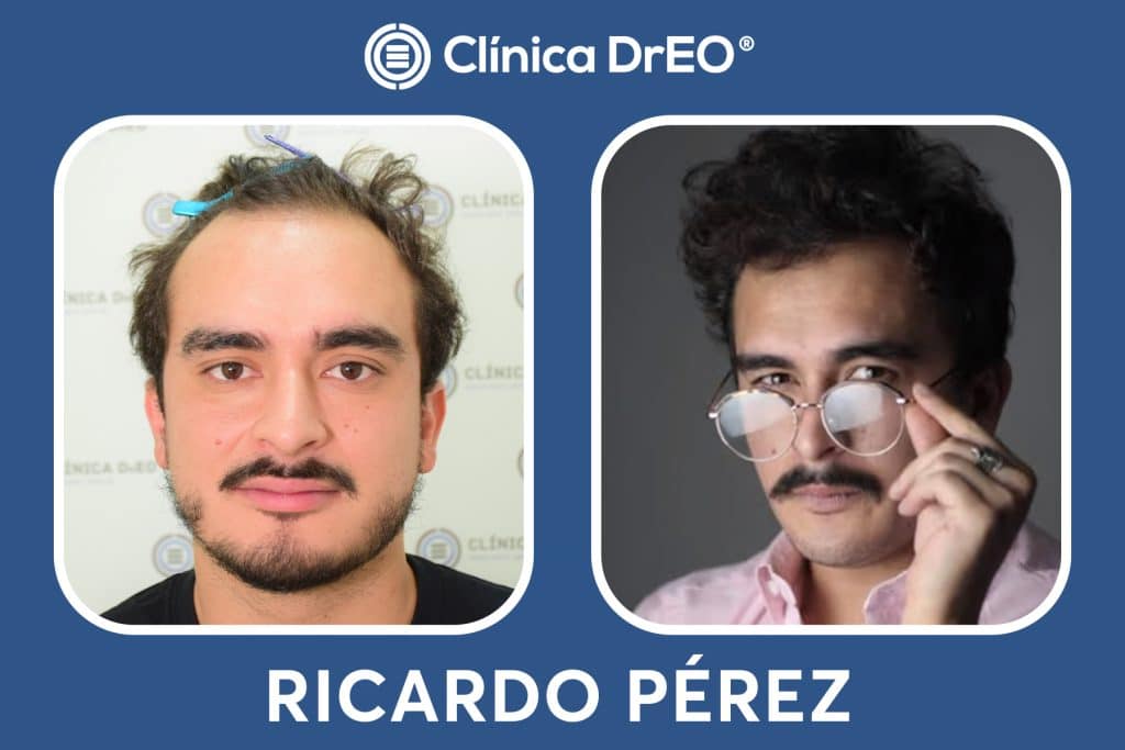 Injerto Capilar: Resultados Antes y Después Reales 4 Resultados Injerto Capilar Ricardo Perez