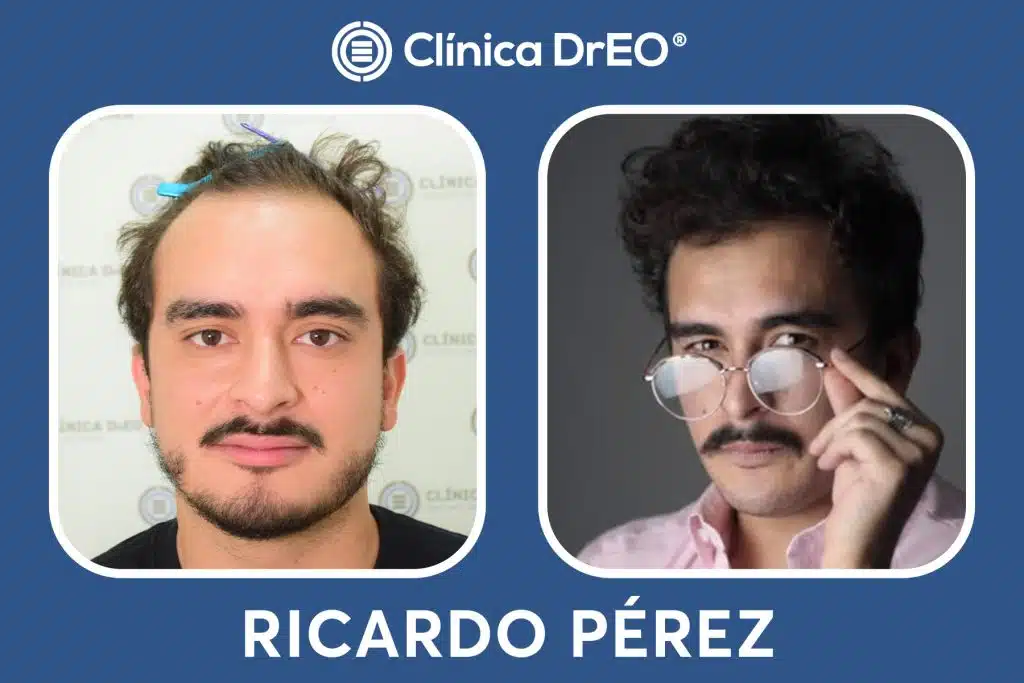 Resultados Injerto Capilar Ricardo Perez