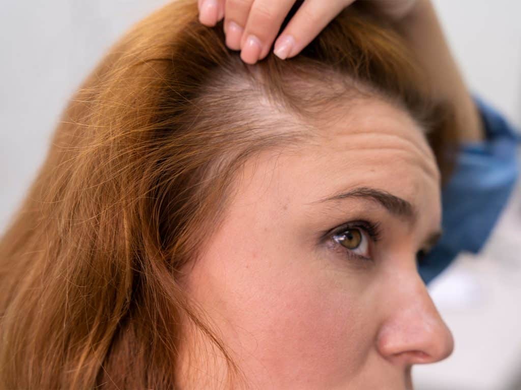 Alopecia en mujeres: 4 tipos y cómo identificarla a tiempo 2 Tipos mas comunes de alopecia en mujeres