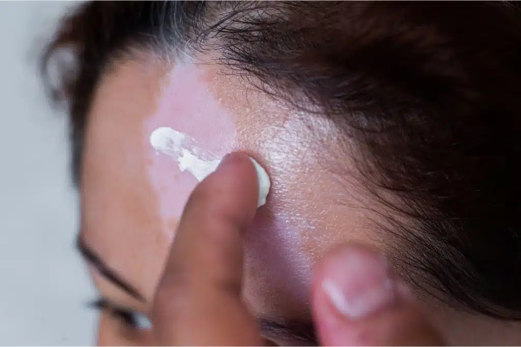 Psoriasis en la cabeza: 5 causas, síntomas y tratamientos efectivos 4 Tratamientos efectivos para la psoriasis en la cabeza