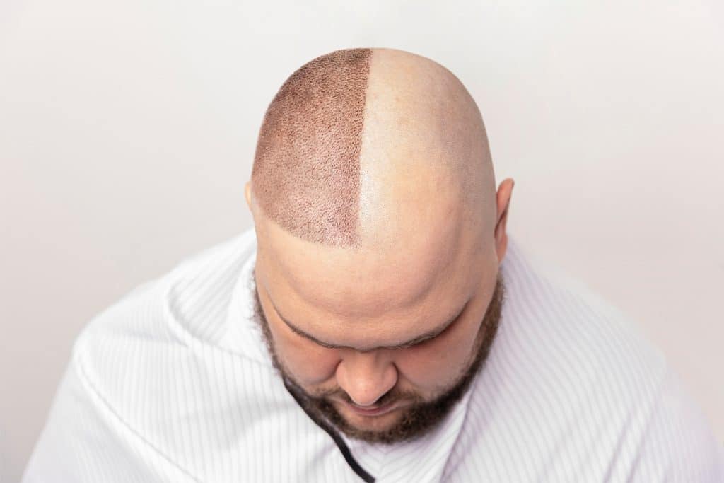 ¿Minoxidil o trasplante capilar Factores que debes considerar