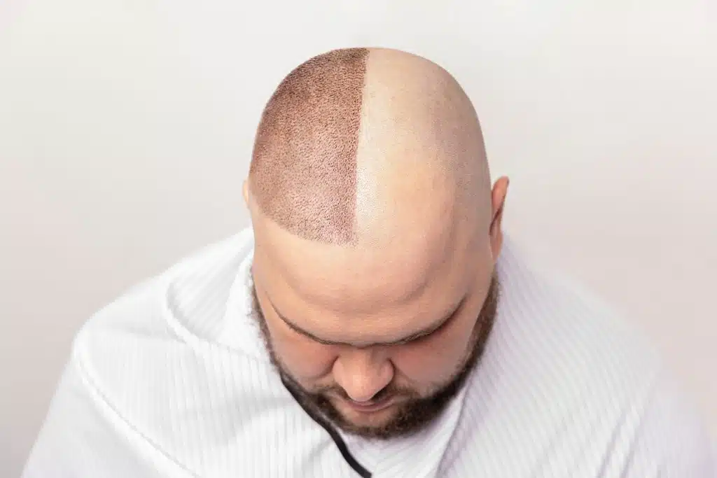 ¿Minoxidil o trasplante capilar Factores que debes considerar